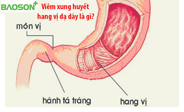 Xung huyết hang vị dạ dày uống thuốc gì?