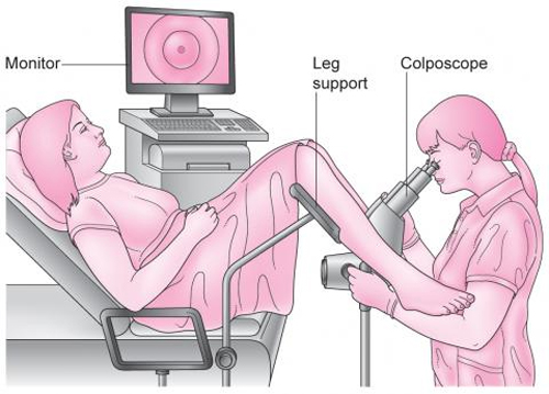 Xét nghiệm chỉ số CA – 125