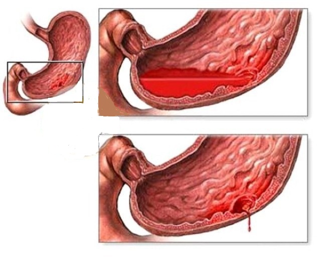 Biến chứng nguy hiểm của đau dạ dày1