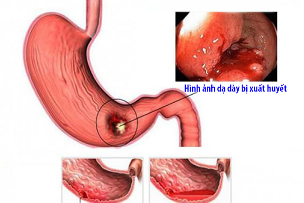 4. Chẩn đoán và điều trị xuất huyết dạ dày