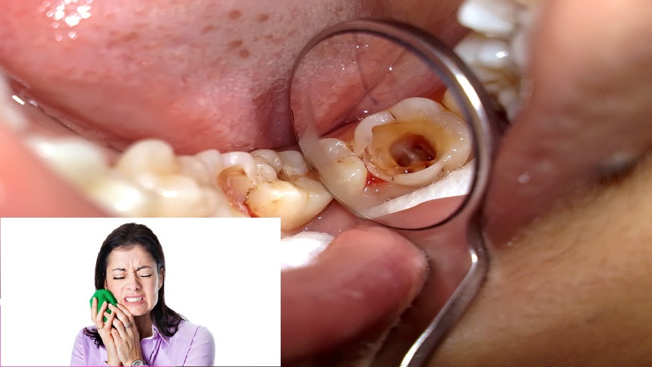 Nguyên nhân gây đau răng và cách phòng tránh