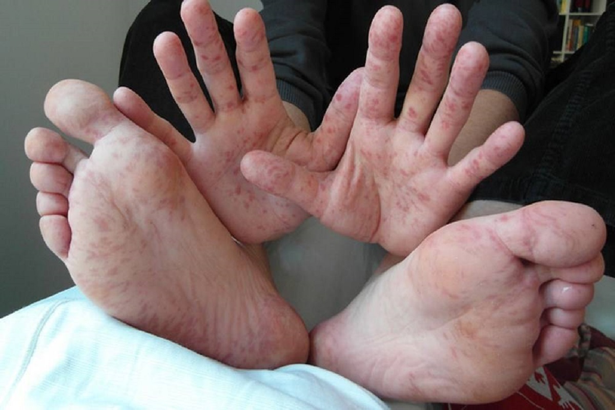Bệnh tay chân miệng có dấu hiệu tăng nhanh - Cha mẹ cần cảnh giác biểu hiện biến chứng nặng