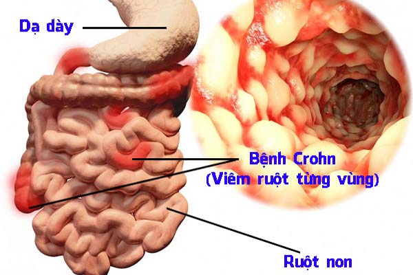 Bệnh Crohn - Viêm ruột từng vùng