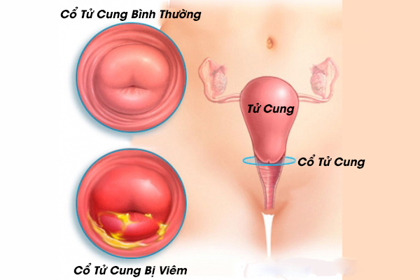 Viêm cổ tử cung: Dấu hiệu, nguyên nhân và cách điều trị