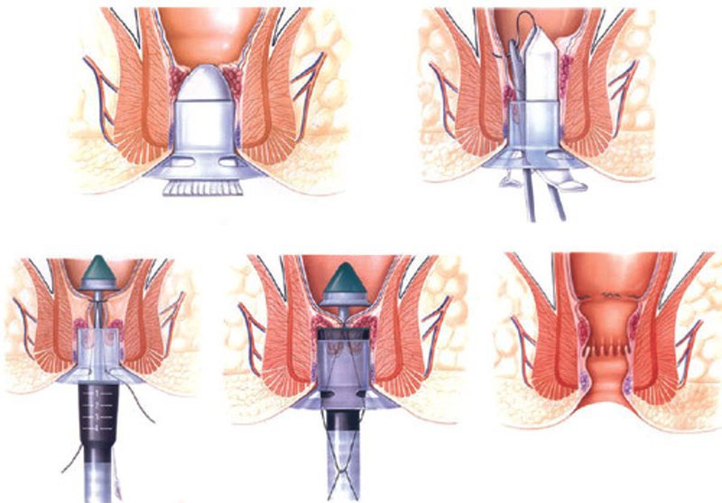 Các bước phẫu thuật cắt trĩ bằng kỹ thuật Longo