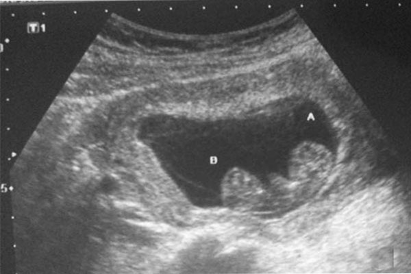 Thông tin hữu ích về siêu âm thai và thăm khám tam cá nguyệt đầu tiên