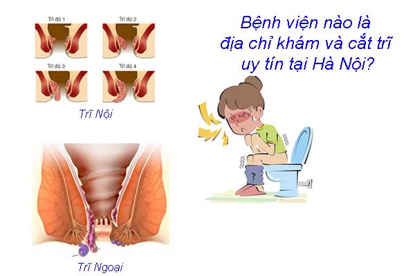 Bệnh viện nào là địa chỉ khám và cắt trĩ uy tín tại Hà Nội