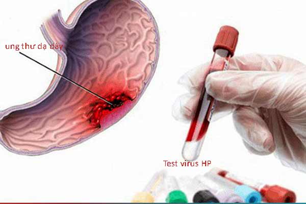 Kiểm tra Virus HP phòng ngừa ung thư dạ dày