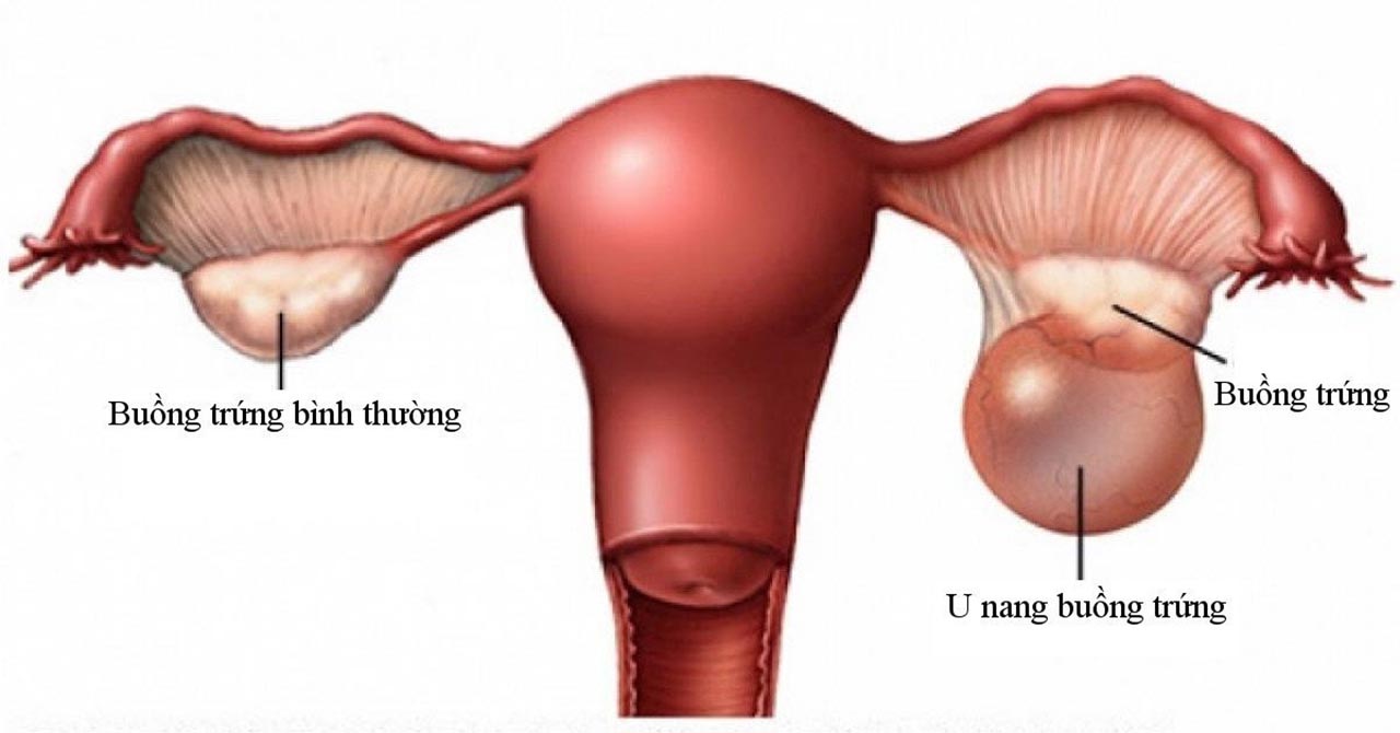 Có thể bạn chưa biết – Khi nào cần phẫu thuật u nang buồng trứng?