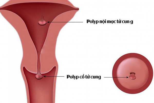 Mẹ bầu bị polyp cổ tử cung có "nguy hiểm" đến thai nhi không?