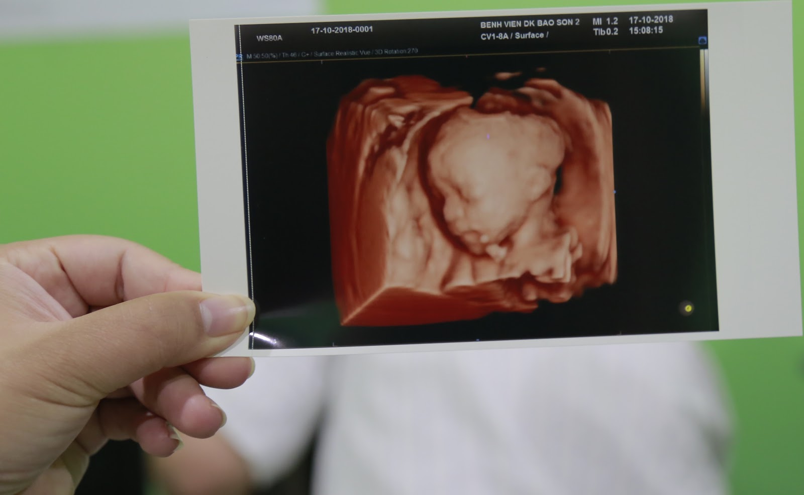 Tại sao nên siêu âm thai 5D tại bệnh viện đa khoa Bảo Sơn
