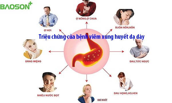 Các triệu chứng của bệnh viêm xung huyết dạ dày
