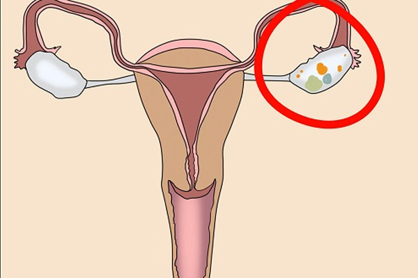 hình ảnh minh họa u nang buồng trứng 