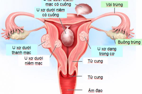U xơ tử cung ảnh hưởng thế nào với mẹ bầu?