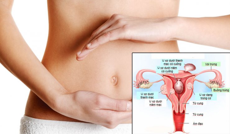 Đau bụng dưới ở nữ giới cảnh báo bệnh phụ khoa nguy hiểm 3