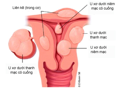 Các vị trí khối u xơ tử cung.
