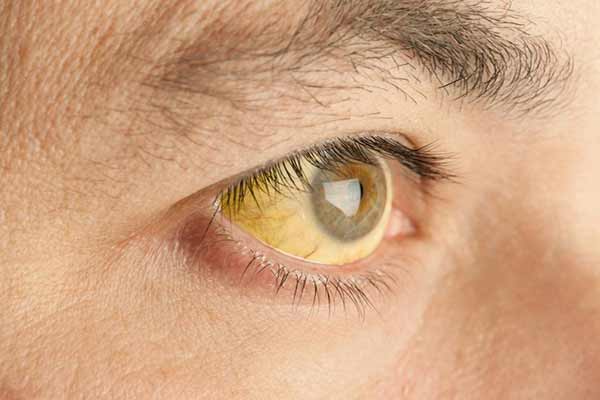 Vàng da vàng mắt dấu hiệu nhận biết sỏi mật