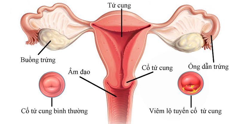 Viêm lộ tuyến cổ tử cung có thể dẫn tới ung thư cổ tử cung?