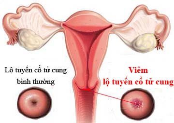 Viêm lộ tuyến cổ tử cung: Cẩn thận với những biến chứng nguy hiểm