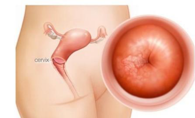Viêm lộ tuyến cổ tử cung: Hiểu đúng để chữa trị hiệu quả