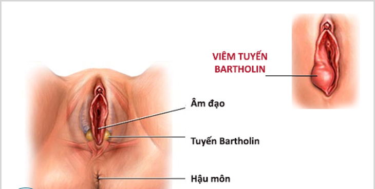 điều trị viêm tuyến bartholin