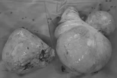 Chủ quan không điều trị, nữ bệnh nhân U40 phải cắt tử cung bán phần vì khối u xơ khủng 2,5kg trong tình trạng thiếu máu nặng 