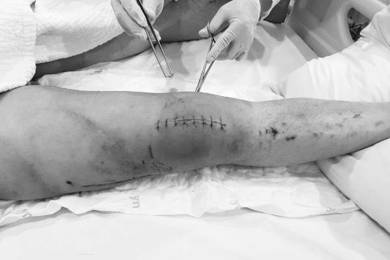 Phẫu thuật thành công kết xương bánh chè cho bệnh nhân Mỹ gốc Hàn