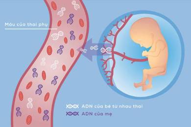Sàng lọc trước sinh không xâm lấn NIPT: 