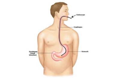 Nội soi thực quản có đau không ? Những điều cần lưu ý