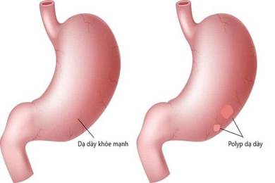 Polyp dạ dày có tiến triển thành ung thư không?