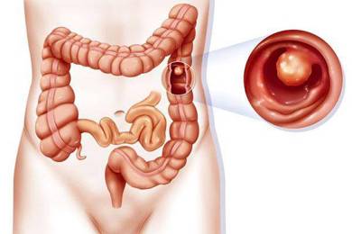Polyp đại tràng có phát triển thành ung thư không?