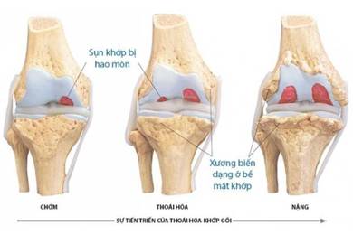 Bệnh thoái hóa khớp gối có nguy hiểm không?