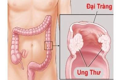 Làm thế nào để phòng tránh ung thư đại trực tràng?