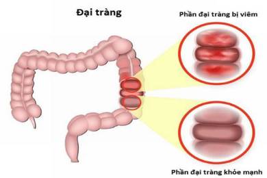 Bệnh viêm đại tràng mãn tính: Bệnh lý không thể coi thường 