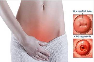 Viêm lộ tuyến cổ tử cung và nguy cơ gây vô sinh hiếm muộn