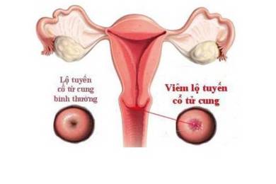 Viêm lộ tuyến cổ tử cung có khả năng tái phát không?