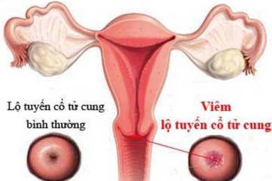 Viêm lộ tuyến cổ tử cung: Cẩn thận với những biến chứng nguy hiểm