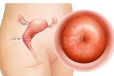 Viêm lộ tuyến cổ tử cung: Hiểu đúng để chữa trị hiệu quả