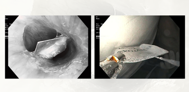 Hy hữu nội soi gắp viên thuốc còn nguyên vỏ nhôm trong thực quản bệnh nhân U80