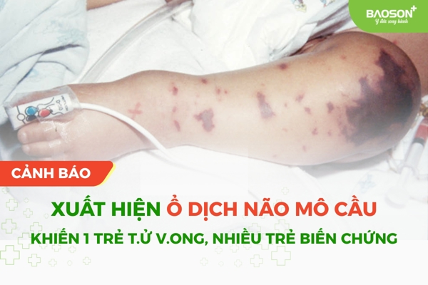 Cảnh báo dịch não mô cầu diễn biến phức tạp – Thiết lập ngay 3 “hàng rào” bảo vệ trẻ từ sớm