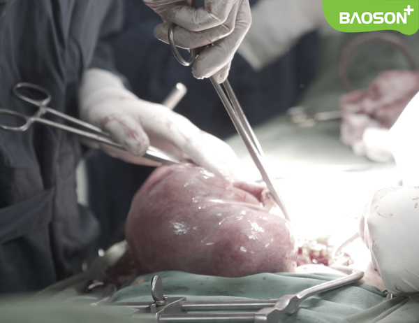 Chủ quan “nuôi” khối u xơ tử cung 4 năm không chữa trị, bệnh nhân 50 tuổi phải cắt bỏ hoàn toàn tử cung và hai phần phụ