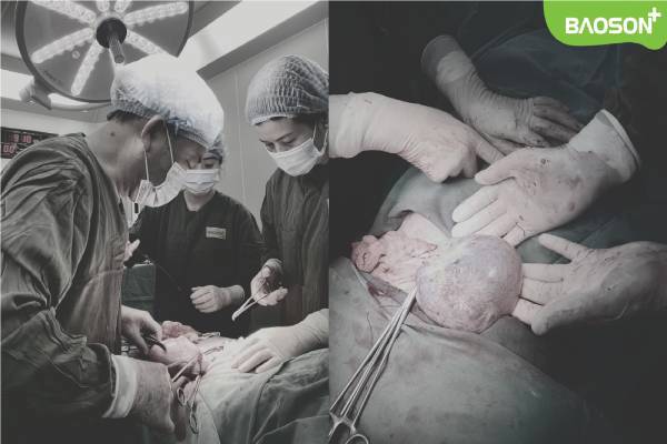 Mổ “2 trong 1” lấy thai kết hợp bóc u nang buồng trứng khủng ở vị trí khó