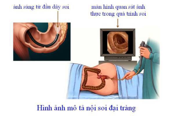 4 lưu ý  trước khi nội soi đại tràng 