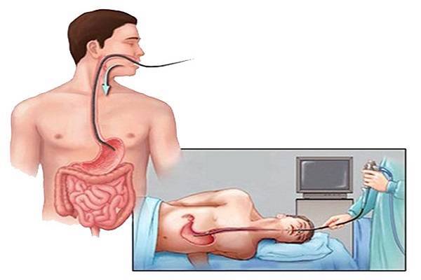Nội soi tiêu hóa không đau “đập tan” nỗi ám ảnh