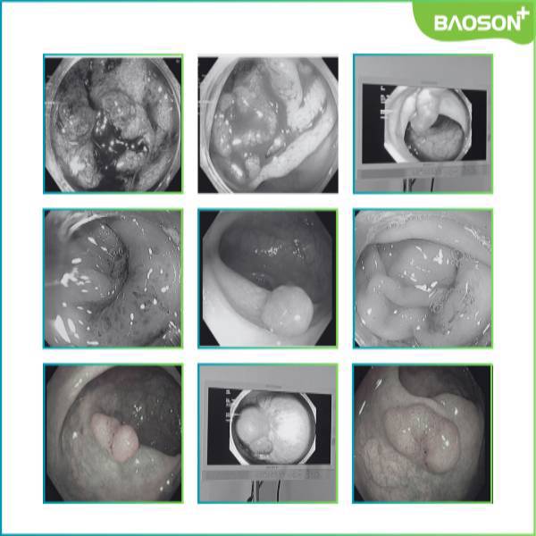 Bệnh nhân 62 tuổi ung thư đại tràng sigma giai đoạn muộn đã di căn gan vì chủ quan với bệnh lý tiêu hóa thông thường!