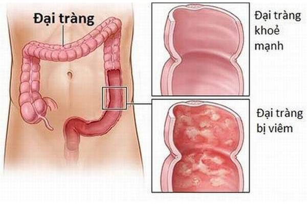 Bệnh viêm đại tràng có nguy hiểm không?