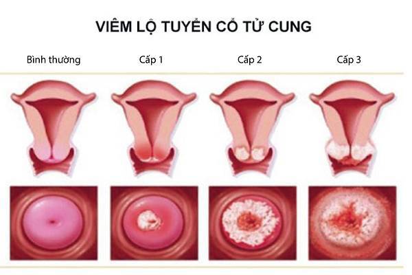 Viêm lộ tuyến cổ tử cung 1cm có nguy hiểm không?