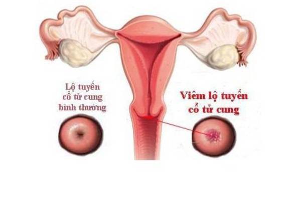 Viêm lộ tuyến cổ tử cung có khả năng tái phát không?
